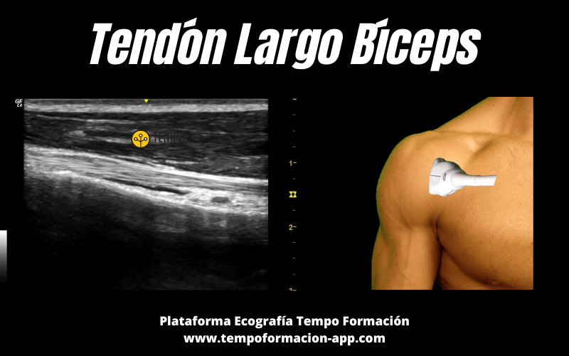 299. Anisotropía Tendón del Bíceps. – Ecografía Fácil