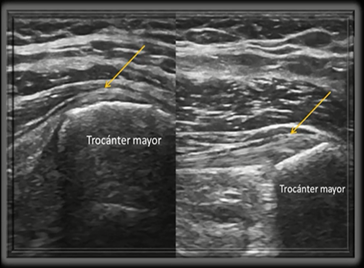 convencional-vs-actual-tendon-insercion-gluteo-medio