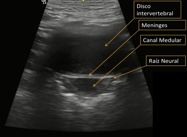 disco-intervertebral-lumbar-ecografia-con-ana-de-groot