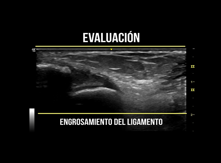 evaluacion-ligamento-peroneoastragalino-anterior