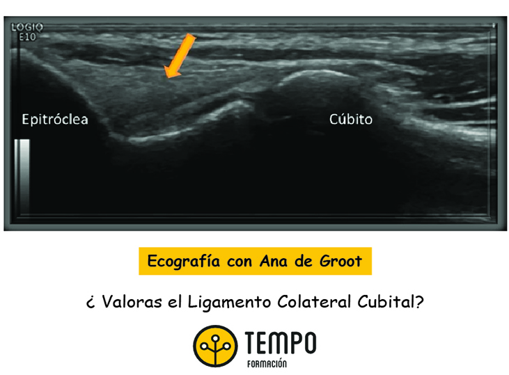 ligamento-colateral-cubital-ecografia-con-ana-de-groot