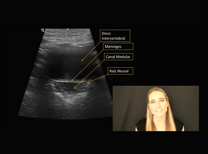 exploracion-disco-intervetebral-lumbar