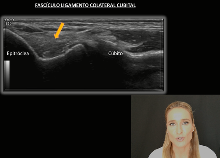 exploracion-ligamento-colateral-cubital