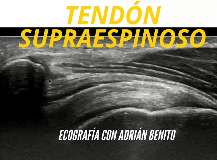 tendon-supraespinoso-ecografia-con-adrian-benito