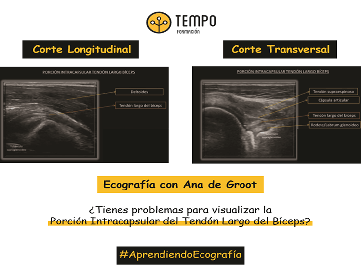 porcion-intracapsular-del-tendon-largo-del-biceps