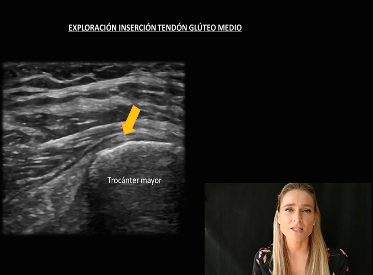 exploracion-tendon-insercion-gluteo-medio-convencional-vs-actual