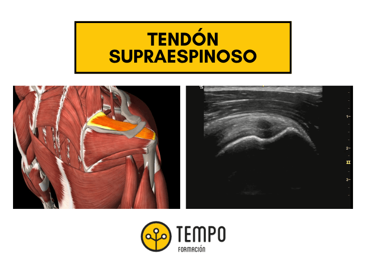 caso-clinico-tendon-supraespinoso