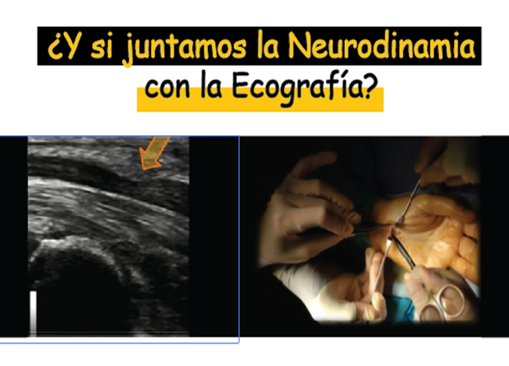 neurodinamia-sindrome-tunel-del-carpo